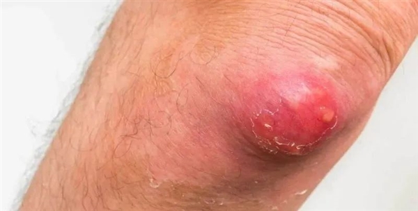 这种“红包”又痛又肿 硬挤真的很危险