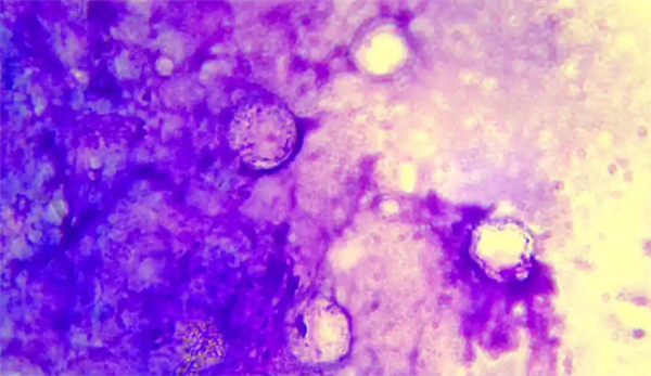 广西一女子左眼剧痛眼球差点不保!医生:感染了食脑虫